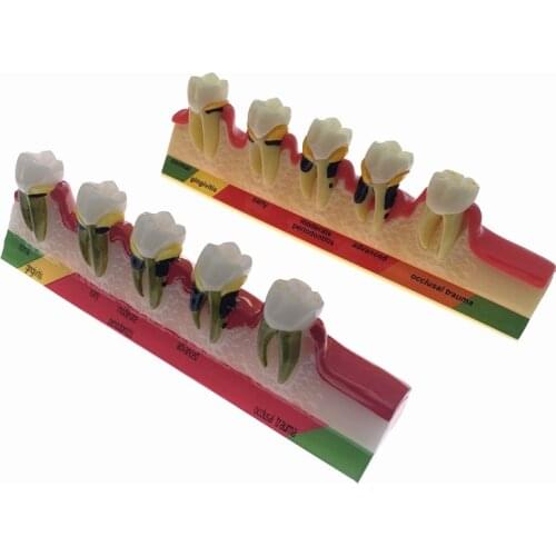 Odontologia Periodontal Disease Dental Teeth Model Tooth research model for dentistry students