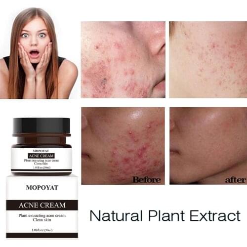 30ml Acne Removal Cream Anti Acne Treatment Face Cream Oil-Control Moisturizing Whitening Facial Care Pores Shrinking Skin Care