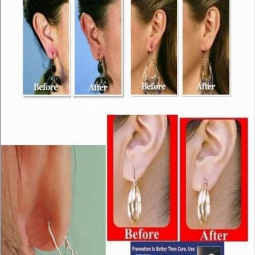 Invisible lobe lift patch as Ear Lobe Support Tape for prevent stretched or torn ear lobes protect sticker AS SEEN ON TV