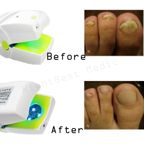 Rechargeable Nail Fungus Laser Treatment Device Onychomycosis Cure Treat Nail Fungus and Infections