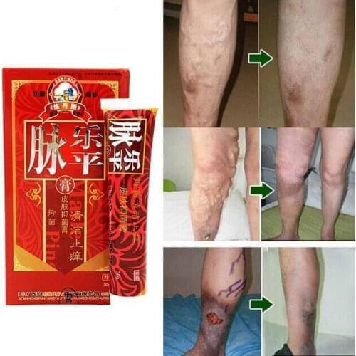 Varicose Veins Treatment Cream Effective cure Vasculitis Phlebitis Varicosity Angiitis ointment