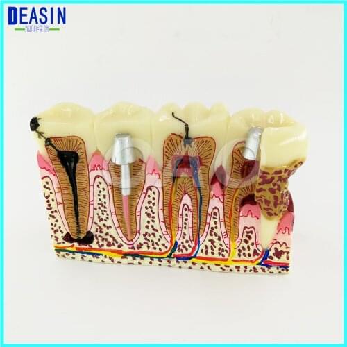 2018 High Quality Dentistry Rich Details Teaching Aids Equipment Caries Tooth Model Dentist Patient Communication Anatomy Model
