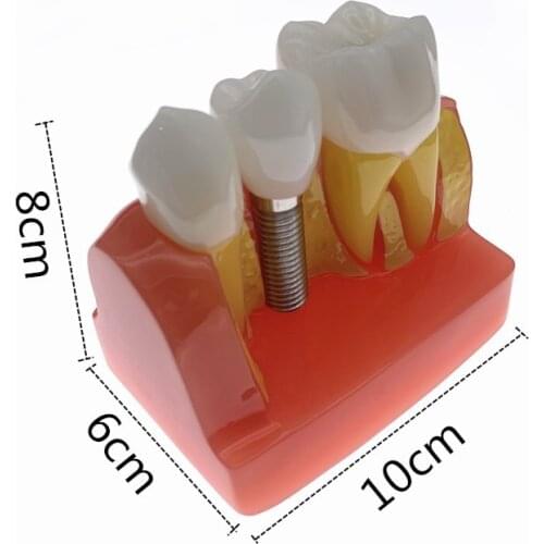 Dental Teach Implant Analysis Crown Bridge Removable Model Dental Demonstration Teeth Model