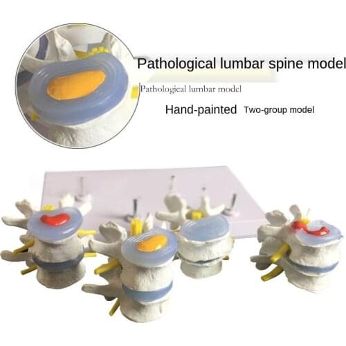 Human skeleton human model vertebral model pathological model lumbar vertebra