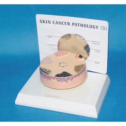 Human Skin Cancer Pathology Enlarged Anatomical Model Medical Teaching Model