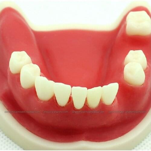 CMAM/12614 Dental- Missing tooth jaw, implant, Human Oral Dental Medical Teaching Anatomical Model