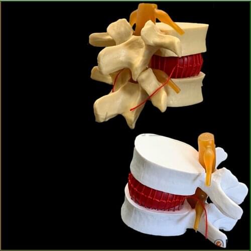 Good Quality 1pcs Human lumbar disc herniation model demonstration model of lumbar vertebral spine model