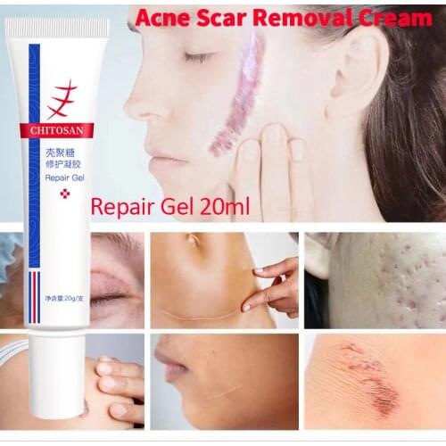 Acne Scar Removal Cream Pimples Stretch Marks Face Gel Remove Acne Smoothing Whitening Moisturizing Body Skin Care Aichun 30ml