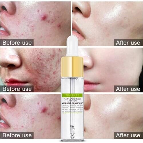 VIBRANT GLAMOUR Tea Tree Acne Treatment Serum Remove Acne Spots Oil Control Shrink Pores Repair Whitening Moisturizing Essence
