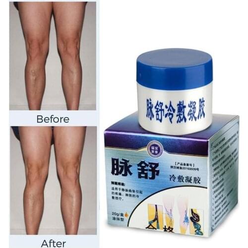 Herbal Medicine For Treating Varicose Vasculitis Phlebitis Legs Veins Relief Pain Massage Cream Treat Varicose Vein Ointment