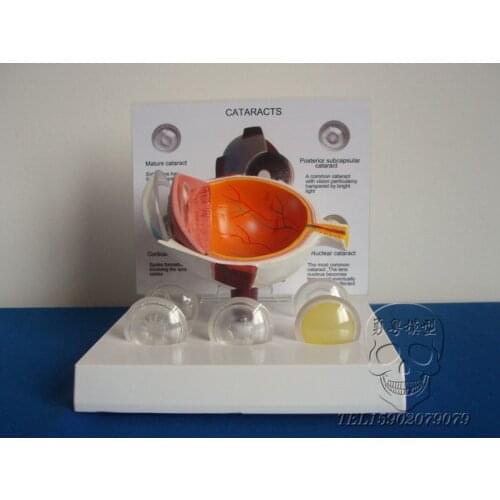 Human eye lesion anatomy model cataracts enlarged eye model educational equipment