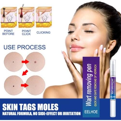 Warts Warts Flat Warts Skin Repair No Trace Beauty Liquid Skin Treatment Papilloma Of Removal Warts Mole Pen Skin Care