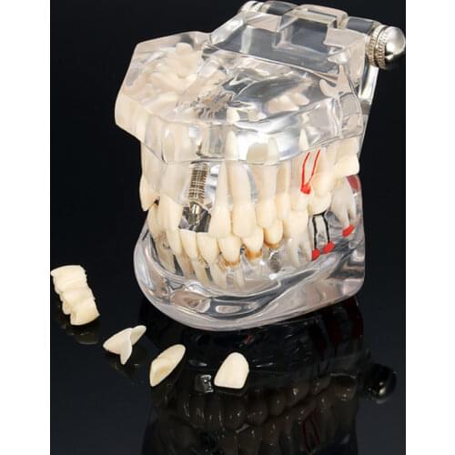Dental Teeth Model Implant Disease With Restoration Bridge Tooth Dentist For Medical Science Dental Disease Teaching Study Tool