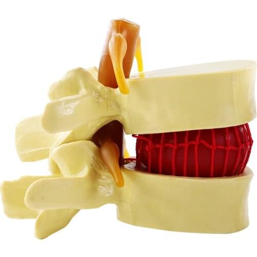 Lumbar spine enlargement intervertebral disc compression model Human spine pathology demonstration joints model