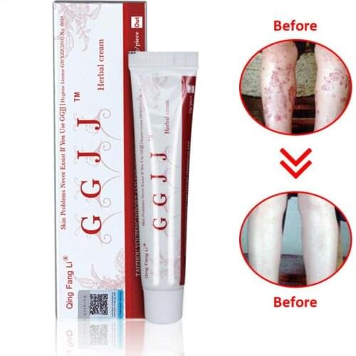 Psoriasis Cream Body Massage Patches Anti Eczeem Psoriasis Cream Works Perfect Relieve All Skin Problems for Itching Patch