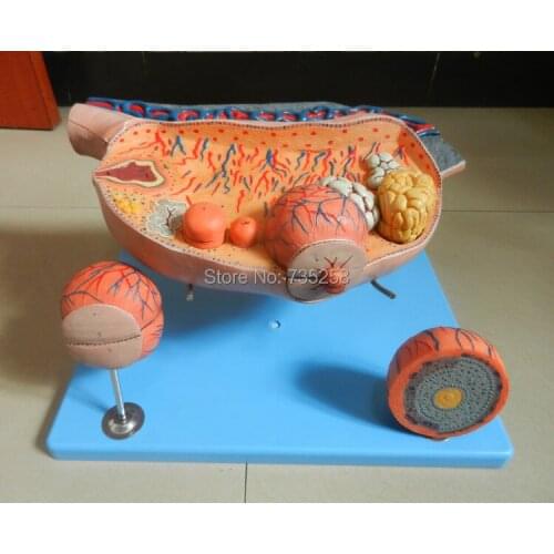 Enlarged Ovary,Women Ovarian Enlargement Model ,The Ovaries Anatomical Model