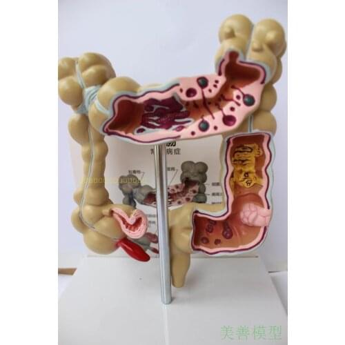 1/2 Life Size Human Rectal Pathology Colon Model Large Intestine Model Anorectal Anatomical Model Tools