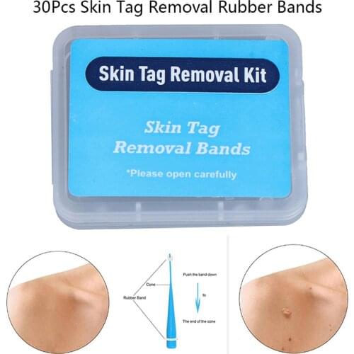 Skin Tag Removal Rubber Bands Micro Band Non Toxic Face Care Mole Wart Skin Care Tools 30Pcs/pack