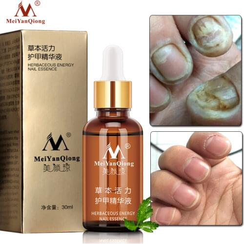 Fungal Nail Repair Essence Serum Care Treatment Whitening Foot Nail Fungus Removal Gel Anti Infection Paronychia Onychomycosis
