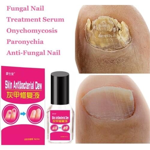 4ml Fungal Nail Treatment Essence Nail and Foot Whitening Toe Nail Fungus Removal Whitening Onychomyco Feet Care Nail Gel Tools