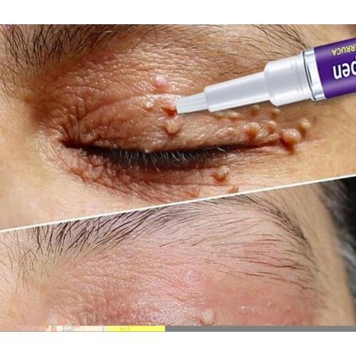 Removal Genital Wart Treatment Papillomas Skin Tags Remedy Rapidly Removing Anti Remover Effective Moles Against Verruca A8X3