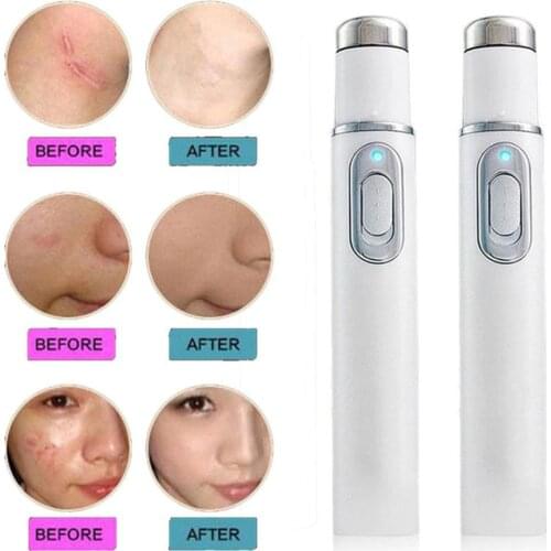Portable Blue Light Therapy Acne Laser Pen Skin Spots Removal Pen Anti Varicose Spider Vein Eraser Treatment