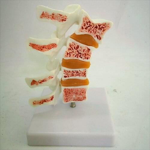 Vertebra Explanation model of anatomical lesions human body osteoporosis Comparative model Femoral head Skeletons