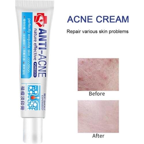 Herbal Traditional Chinese Medicine Acne Treatment Shrink Pores Spots Gel Bleaching Creams Whitening Moisturizing Face Cream