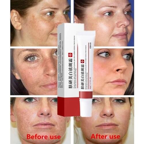 Effective Freckle Cream Remove Dark Spots Acne Spot Pigment Melanin Dark Spots Pigmentation Moisturizing Gel Skin Care Facial
