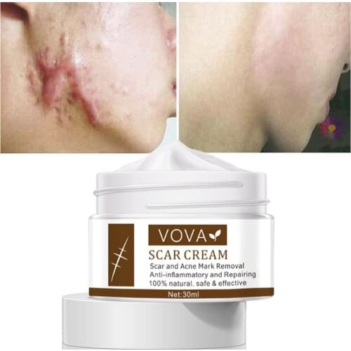 VOVA Scar Removal Cream Pimples Stretch Marks Face Gel Remove Acne Smoothing Whitening Moisturizing Body Cream Skin Care