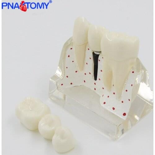 4 TimesTransparent Dental Implant Model Analysis Crown Bridge Demonstration Dental Teeth Dentist Patience Model