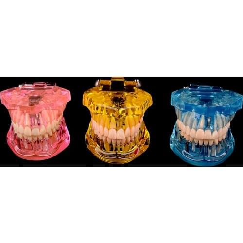 Dental Implant Disease Teeth Model With Restoration Bridge Tooth Dentist For Medical Science Dental Disease Teaching Study