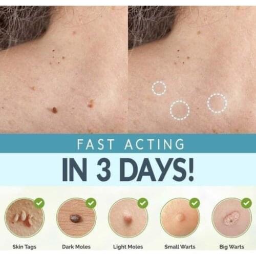 108pcs Skin Moles Acne Removal Patch Pimple Remover Tool Blemish Spot Skin Care Facial Mask