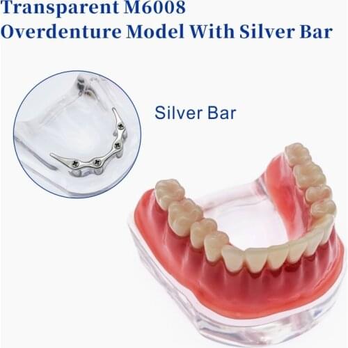 Dental Model With 4 Implant Overdenture Inferior Demo Teeth Study Model 6002 02 Dentalmall