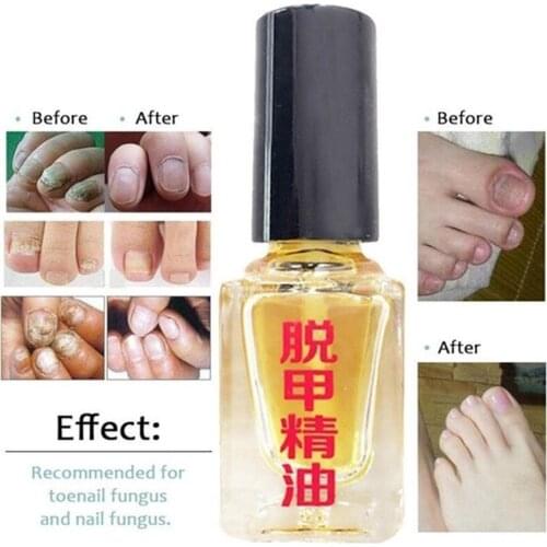 5ML Toe And Fingernail Bright Repairing Treatment Of Liquid Onychomycosis Infection Anti-fungal S9M0