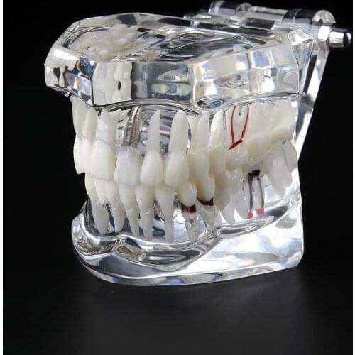 Hot Sale Dental Implant Disease Teeth Model for Medical Teaching Oral Health Care Science Dental Disease Teaching Study