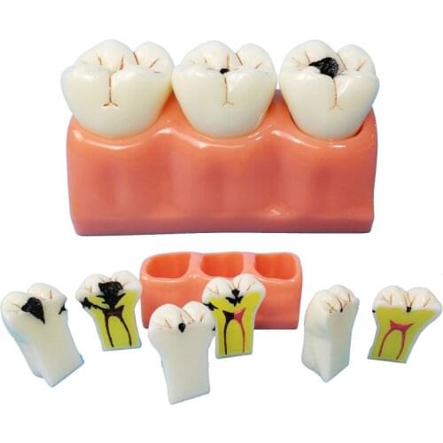 4 Times Caries Disassembling Model Denture Disease Teeth Model for Dentist Tooth Decay Model for Teaching Decomposition model