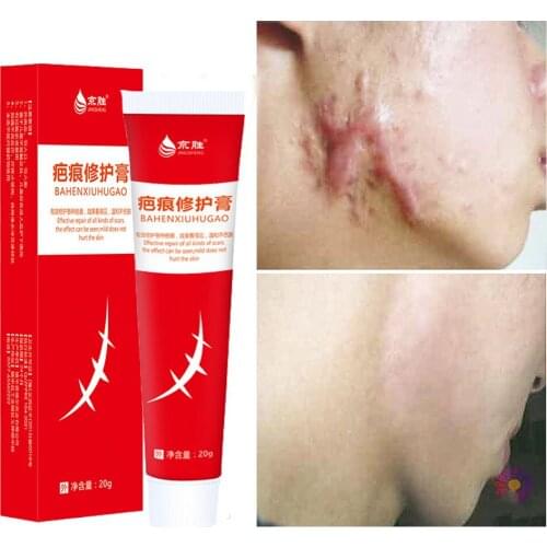 20g Acne Scar Removal Cream Pimples Stretch Marks Face Gel Remove Acne Smoothing Whitening Moisturizing Body Skin Care