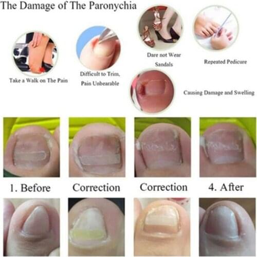 Ingrown Toenail Straightening Clip Brace Foot Care Nails Patch Correction