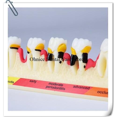 Dental Oral teaching Model/Dental Periodontal disease tooth model M4010/Dental Pathological teeth model