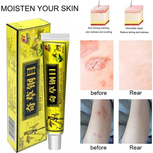 QiCao Eczema Psoriasis Pruritus Antibacterial Dermatitis Herbal Cream 15g Anti-itching body hand foot care Ointment