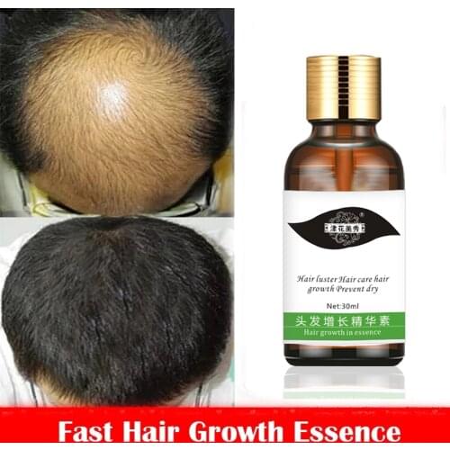 Fast Hair Growth Essence Hair Loss Products Hair Growth Fibras Cabelo Shampoo Cremes De Tratamento Para Cabelos Hair Care
