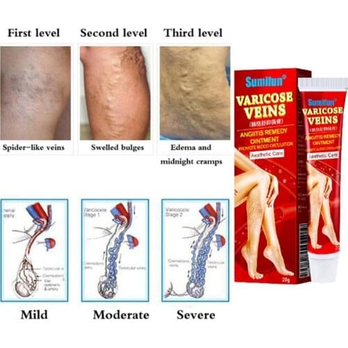 20g New Varicose Veins Treatment Cream 100% Original Spider Medical Plaster Relief Pain Vasculitis Ointment Phlebitis D2H3