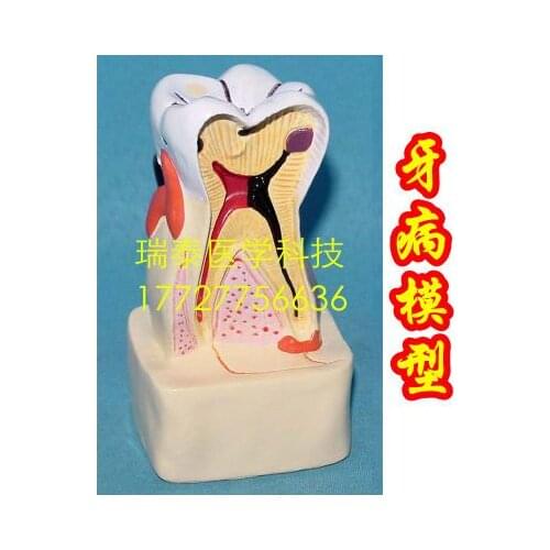Human model 6*5*11CM Caries model Pathological oral models Tooth decay structure of dentin pathology free shipping
