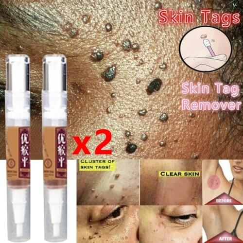 Skin Tag Remover Against Mole & Genital Wart fast RemovWithin al Anti Foot Corn Removal Warts Papillomas Rapidly removes moles