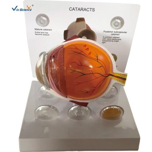 Medical Education Advance Cataract Eye Model Anatomy Model
