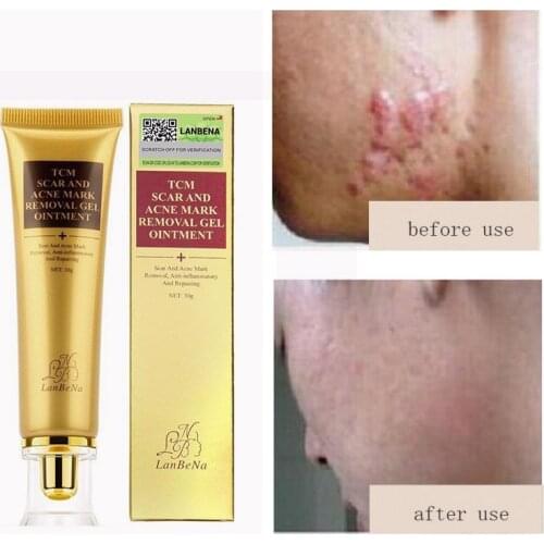 Profession Acne Scar Removal Cream Skin Repair Face Cream Acne Spots Acne Treatment Blackhead Whitening Cream 30ml