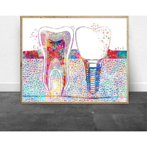 Dental Art Picture Tooth Implant Canvas Print Dentist Wall Art Painting Medicine Hygienist Poster Tooth Water color Clinic Decor