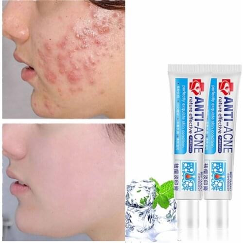 1Pc Anti-Acne Cream Treatment Cream Blackhead Acne Cream Repair Gel Oil Control Shrink Pores Scar Facial Care Whitening Skin 30G
