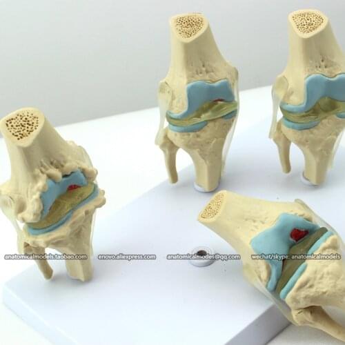 12359/Pathological knee,4 Stage,Anatomical Human Model/CMAM